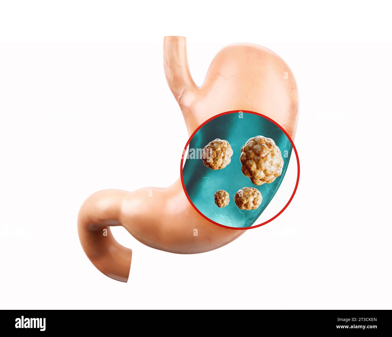 Anatomie de l'illustration réaliste 3d de l'organe interne humain - estomac. Estomac humain avec radiographie du duodénum pour cancer Banque D'Images