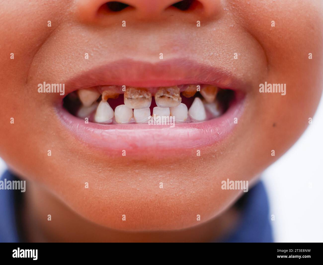 Dents pourries enfant noir Banque de photographies et d'images à haute  résolution - Alamy