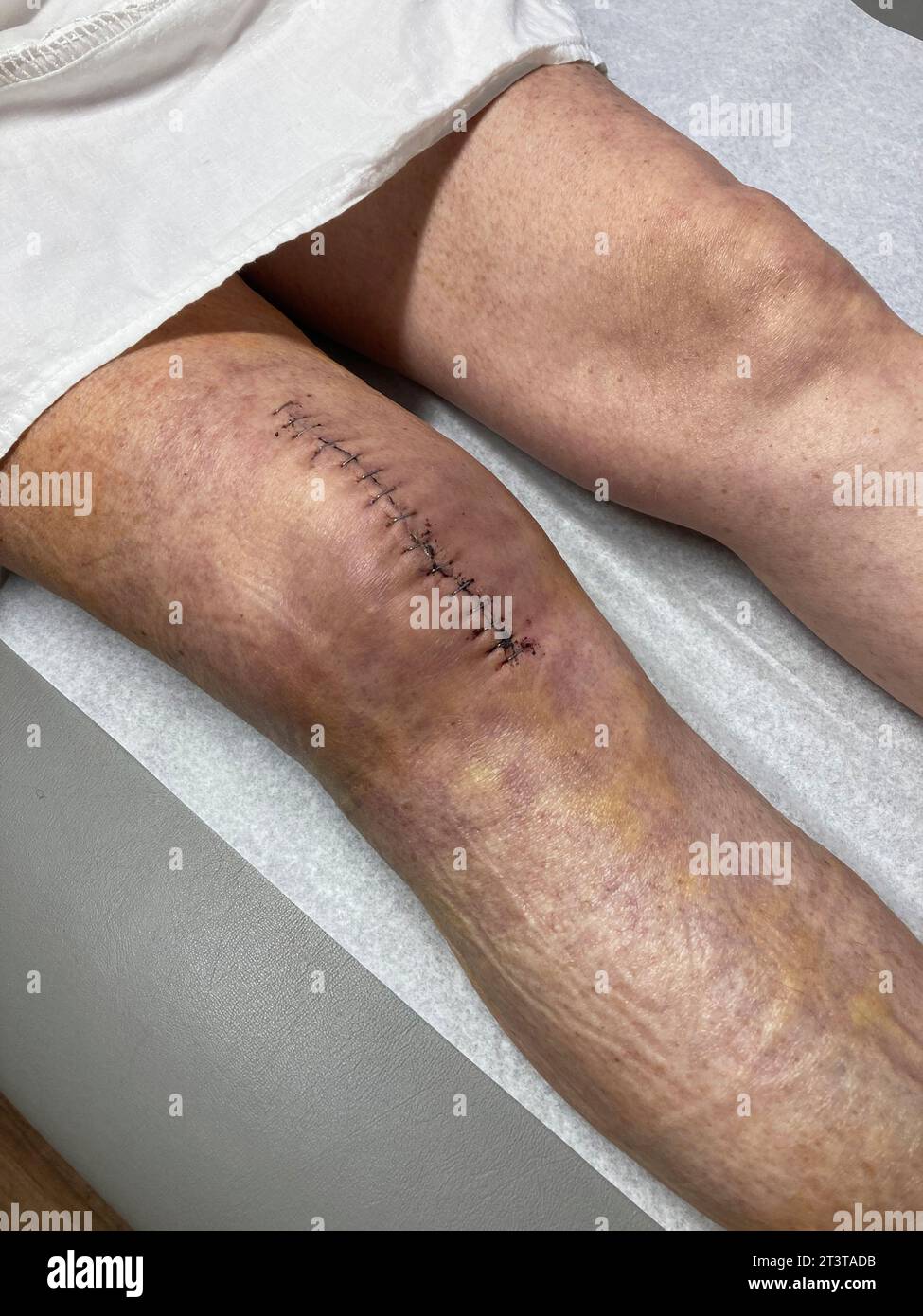 Femme avec une grande cicatrice sur le genou après chirurgie Banque D'Images