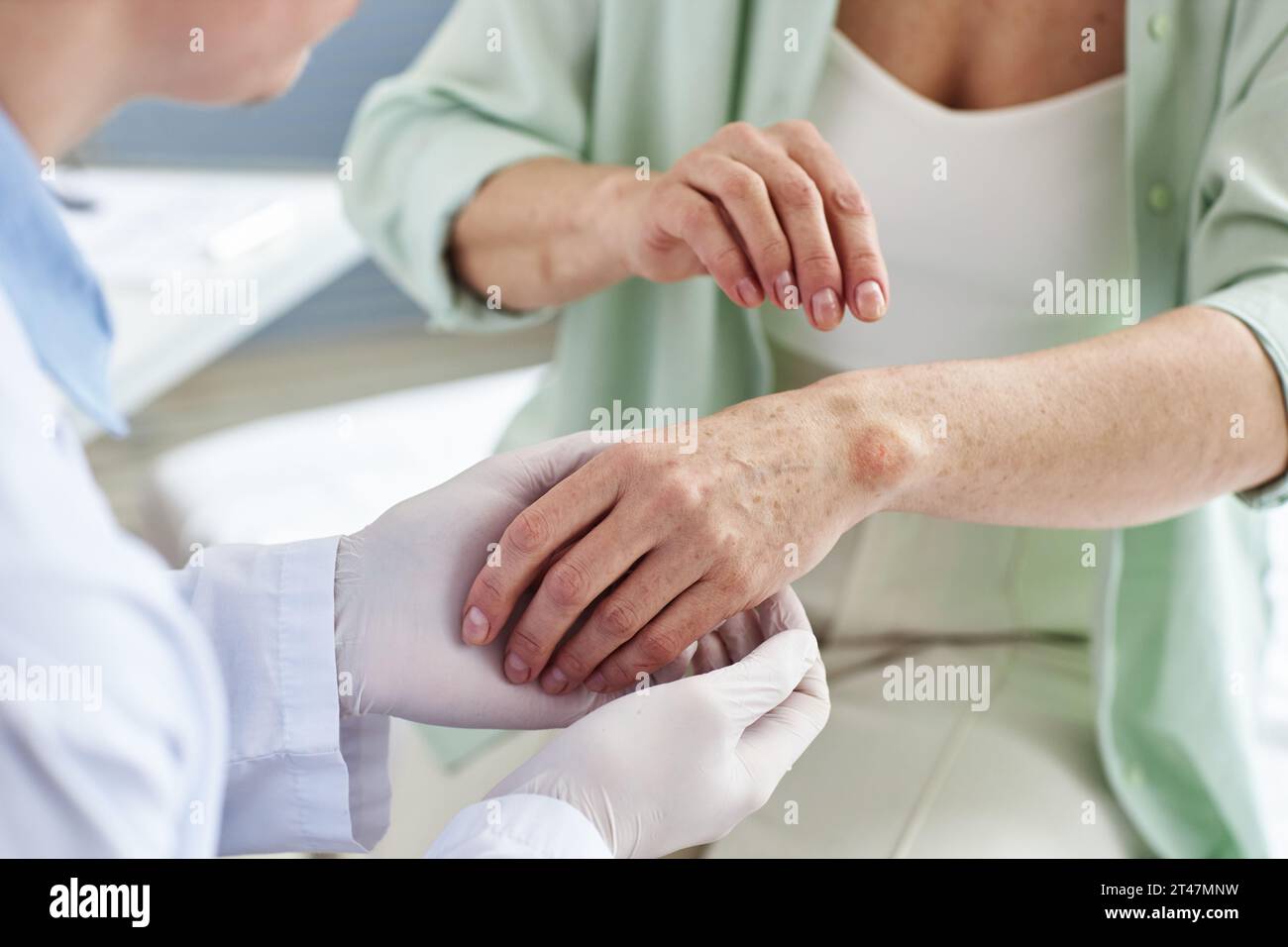 Gros plan du médecin inspectant l'éruption cutanée sur la main d'une patiente dans une clinique de dermatologie, espace de copie Banque D'Images Gros plan du médecin inspectant l'éruption cutanée sur la main d'une patiente dans une clinique de dermatologie, espace de copie Banque D'Images