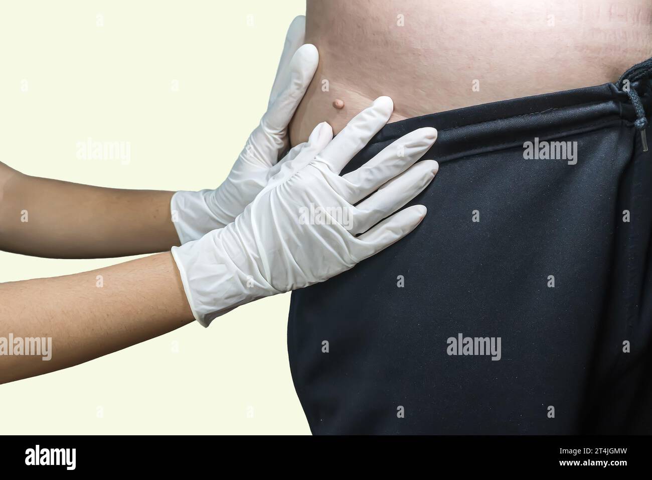 Étiquette de peau ou acrochondon ou fibrome mou est un coffre-fort. Il n'ont pas effet à l'organisme. Elle se produit habituellement au cou, le visage, les aisselles et le corps. Banque D'Images