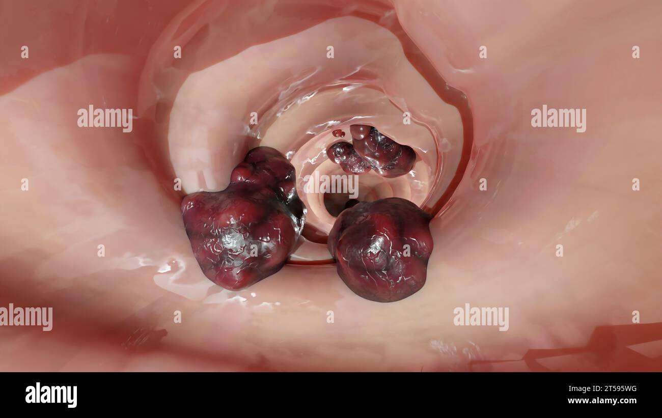 Cancer colorectal, tumeur maligne dans l'intestin, endoscope dans la coloscopie, intestin intestinal, ablation de polypes du côlon, recherche de polypes du côlon, polypectomie, Banque D'Images