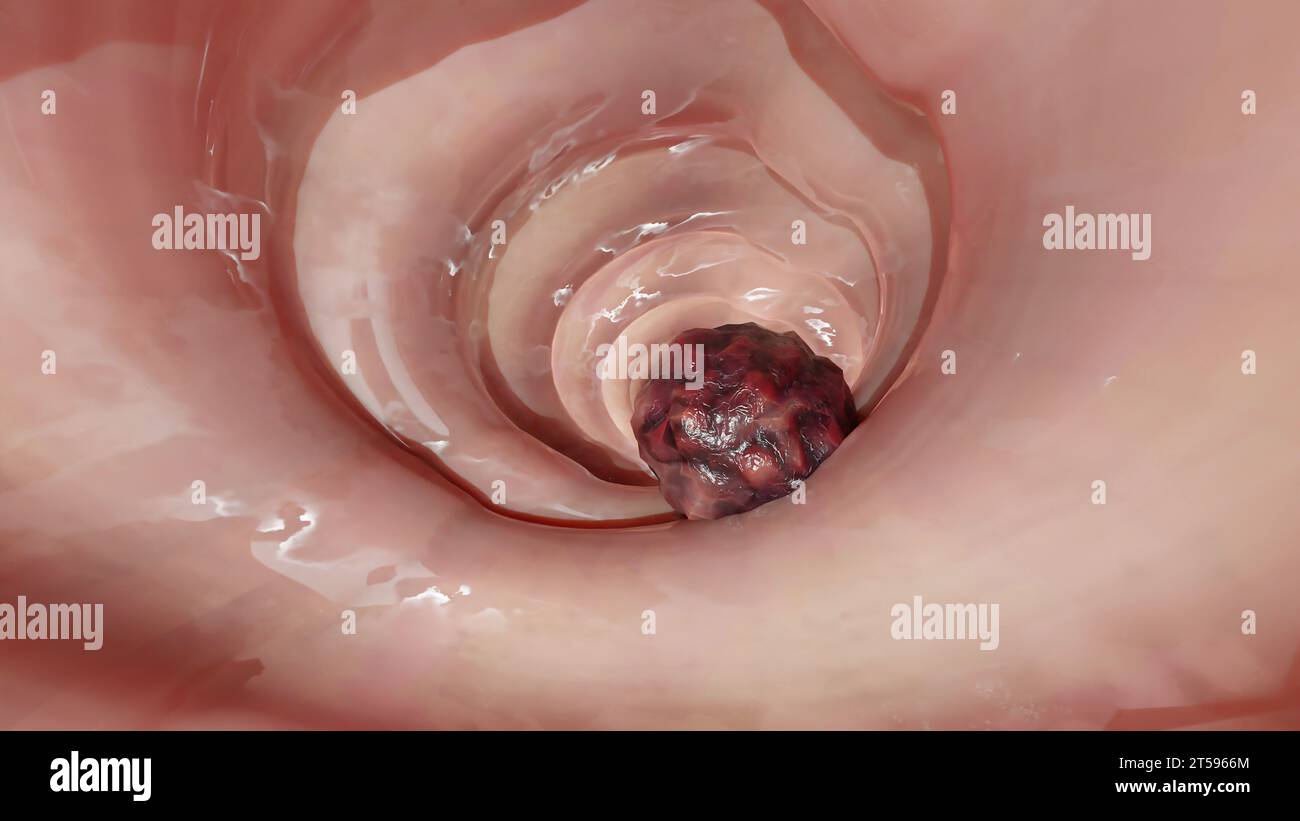 Cancer colorectal, tumeur maligne dans l'intestin, endoscope dans la coloscopie, intestin intestinal, ablation de polypes du côlon, recherche de polypes du côlon, polypectomie, Banque D'Images
