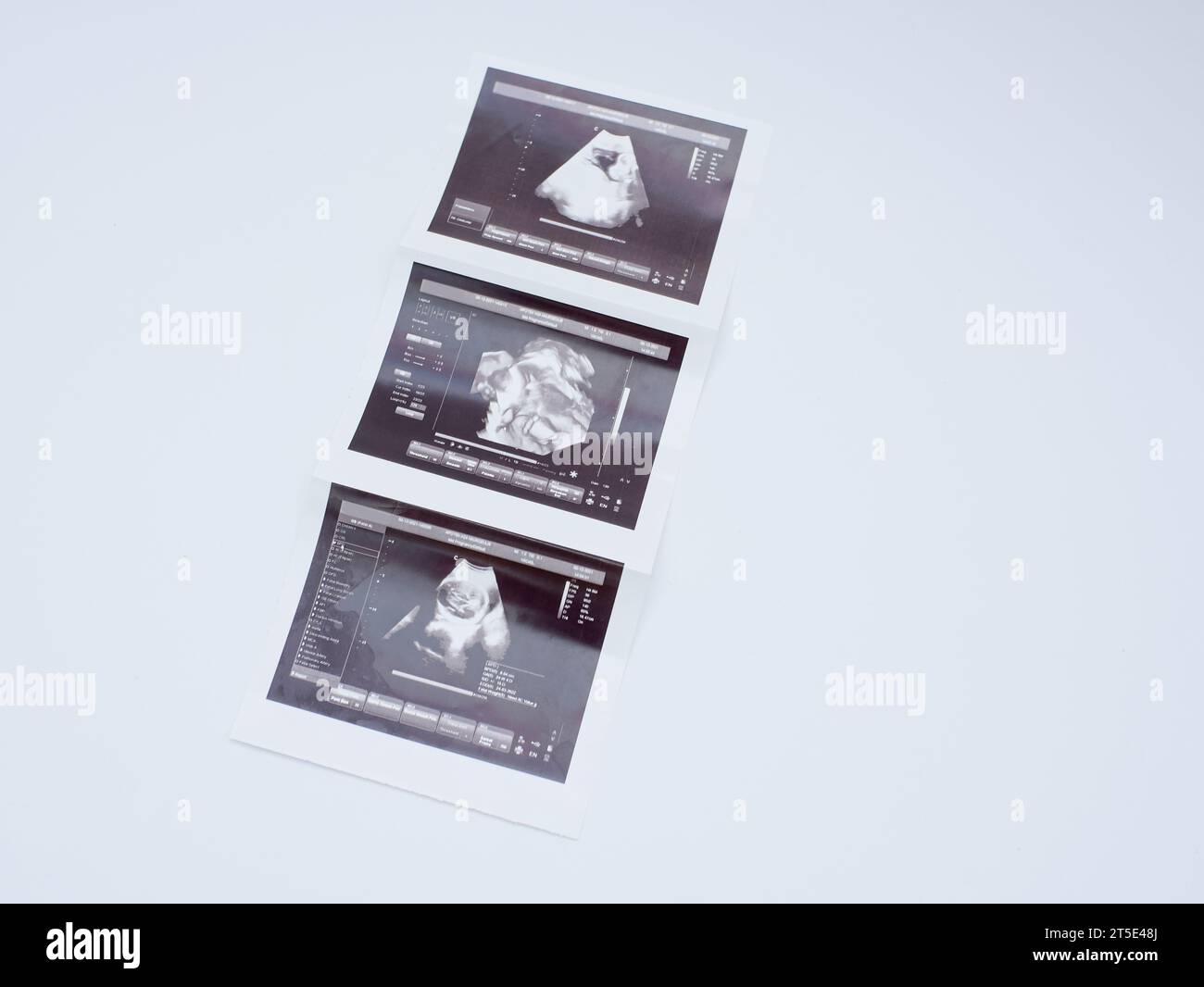 image des résultats échographiques de grossesse isolés sur blanc Banque D'Images