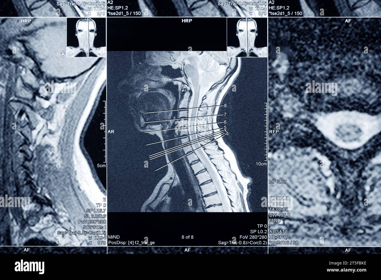 IRM du rachis cervical pour le diagnostic. L'examen médical pour la prévention des maladies. Banque D'Images
