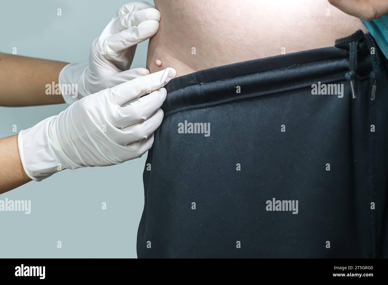 Étiquette de peau ou acrochondon ou fibrome mou est un coffre-fort. Il n'ont pas effet à l'organisme. Elle se produit habituellement au cou, le visage, les aisselles et le corps. Banque D'Images