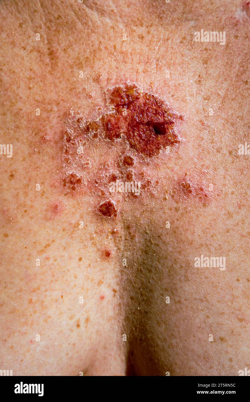 Carcinome basocellulaire superficiel réagissant à la crème imiquimod après un traitement cohérent montrant une lésion rouge sur thorax femme caucasienne de 30 s. Banque D'Images