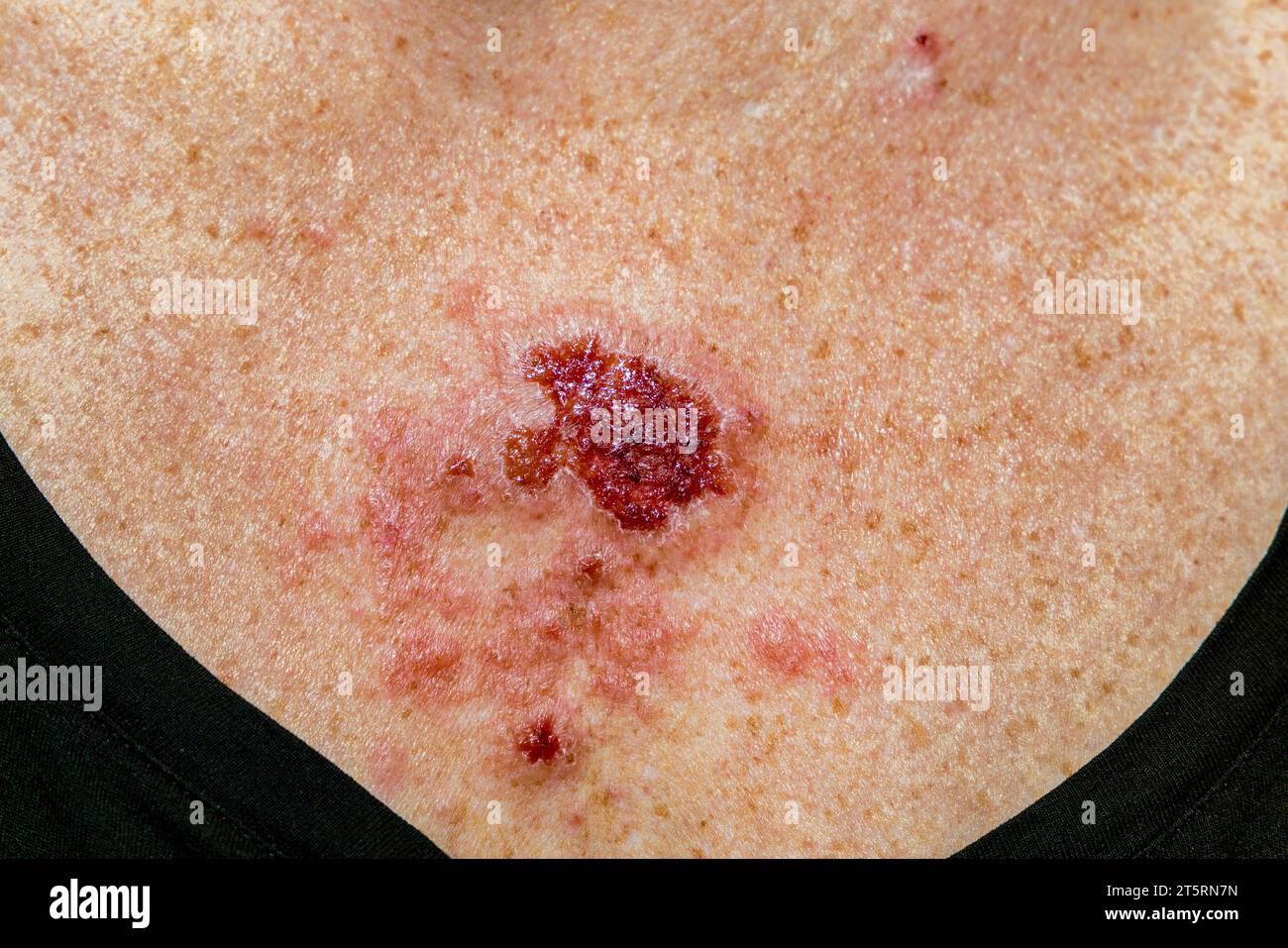 Carcinome basocellulaire superficiel réagissant à la crème imiquimod après un traitement cohérent montrant une lésion rouge sur thorax femme caucasienne de 30 s. Banque D'Images