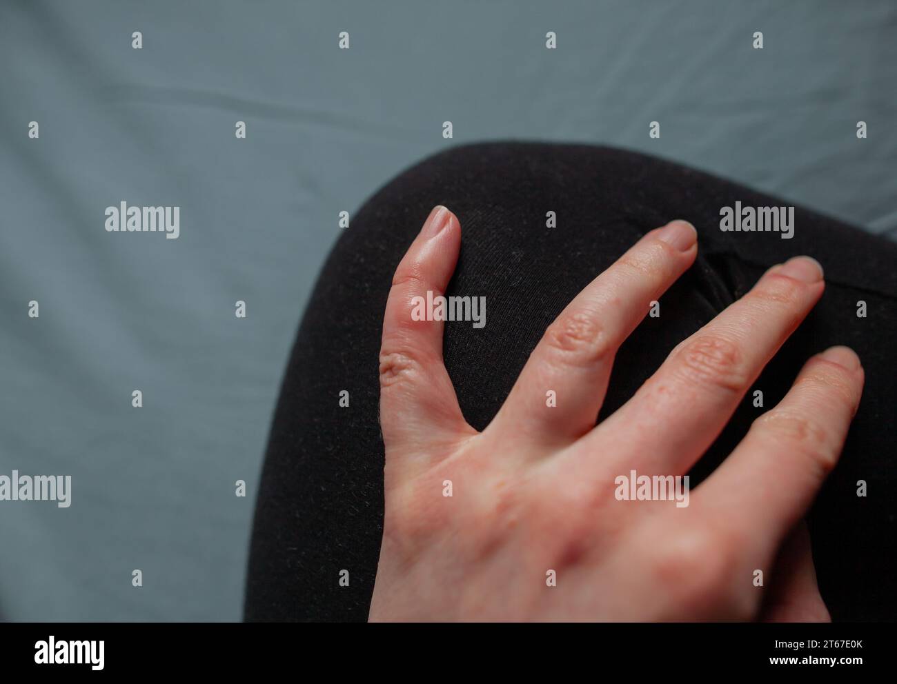 Gros plan photo de chilblains sur les doigts main de fille avec phénomène de Raynaud et lésions chilblains sur les doigts Perniose doigts gonflés rouges Banque D'Images