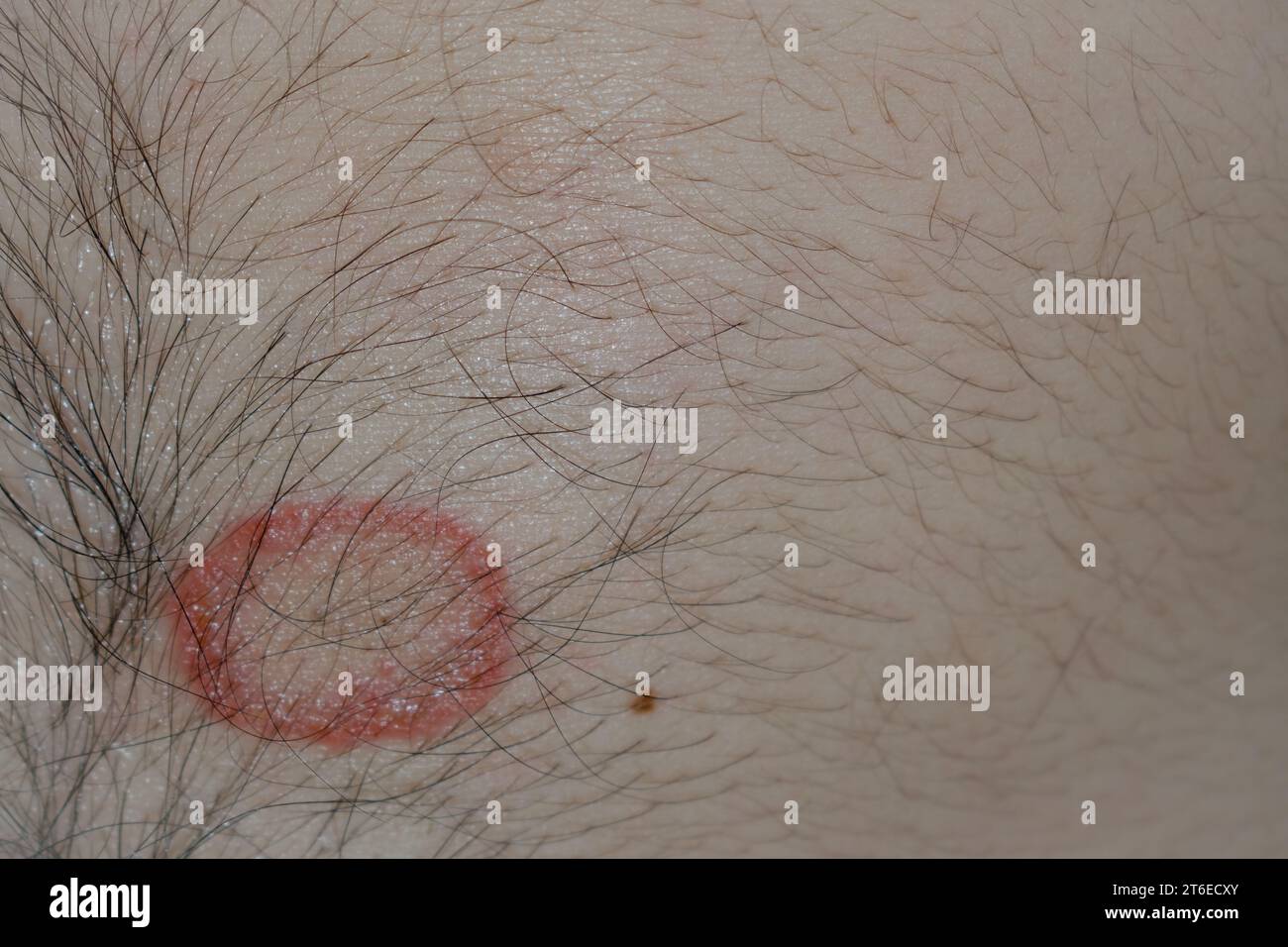 Gros plan détaillé de l'infection fongique du ver de sonnette (Tinea) sur la peau humaine – image haute résolution représentant le rouge distinctif, l'éruption circulaire et l'échelle commune à la dermatophytose ; utile pour des buts médicaux, dermatologiques et d'éducation à la santé pour illustrer les conditions de peau, les symptômes, les causes, la prévention et les options de traitement pour le ver de sonnette et d'autres infections fongiques. Banque D'Images