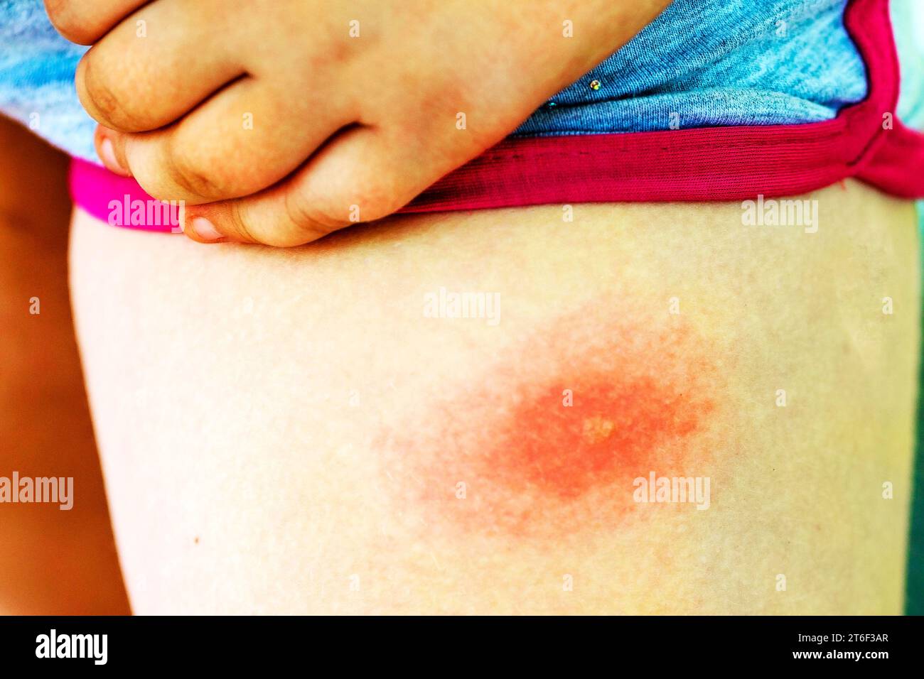 La piqûre de tique sur la jambe d'un enfant, gros plan. Allergie aux piqûres d'insectes. Plaie et conséquences après piqûre de moustique. Peau acnéique Banque D'Images