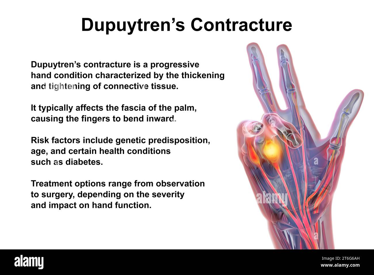 Une illustration médicale 3D montrant la main d'un patient atteint de la maladie de Dupuytren, mettant l'accent sur les tendons et le fascia palmaire affectés pour illustrer l Banque D'Images