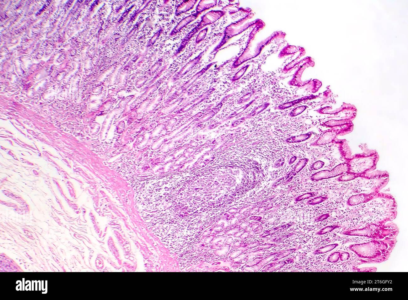 Photomicrographie des métaplasies intestinales, montrant la transformation des cellules de la muqueuse gastrique en cellules intestinales. Banque D'Images