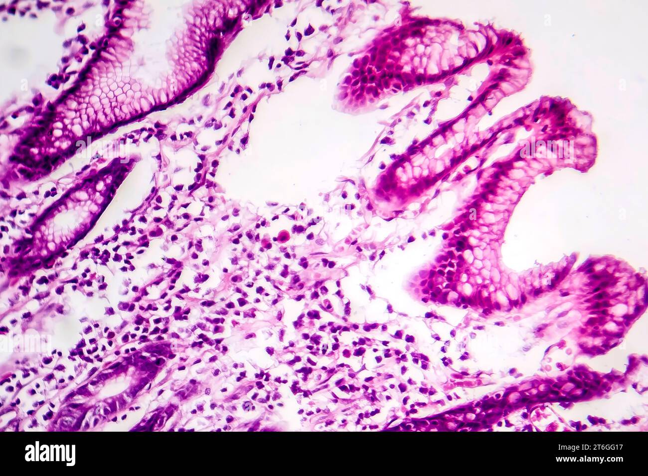 Photomicrographie des métaplasies intestinales, montrant la transformation des cellules de la muqueuse gastrique en cellules intestinales. Banque D'Images