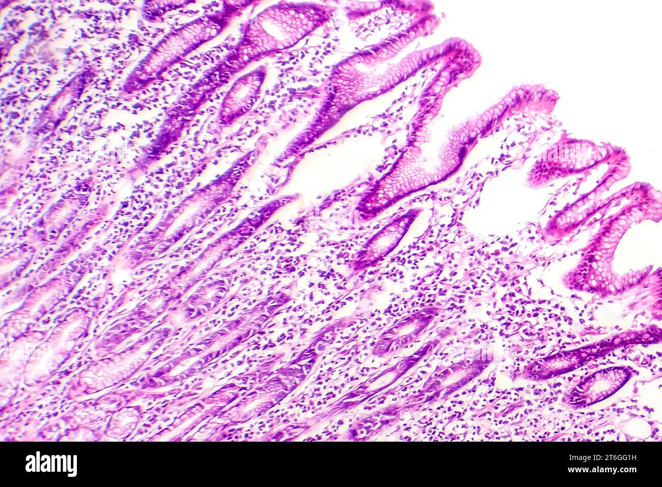Photomicrographie des métaplasies intestinales, montrant la transformation des cellules de la muqueuse gastrique en cellules intestinales. Banque D'Images