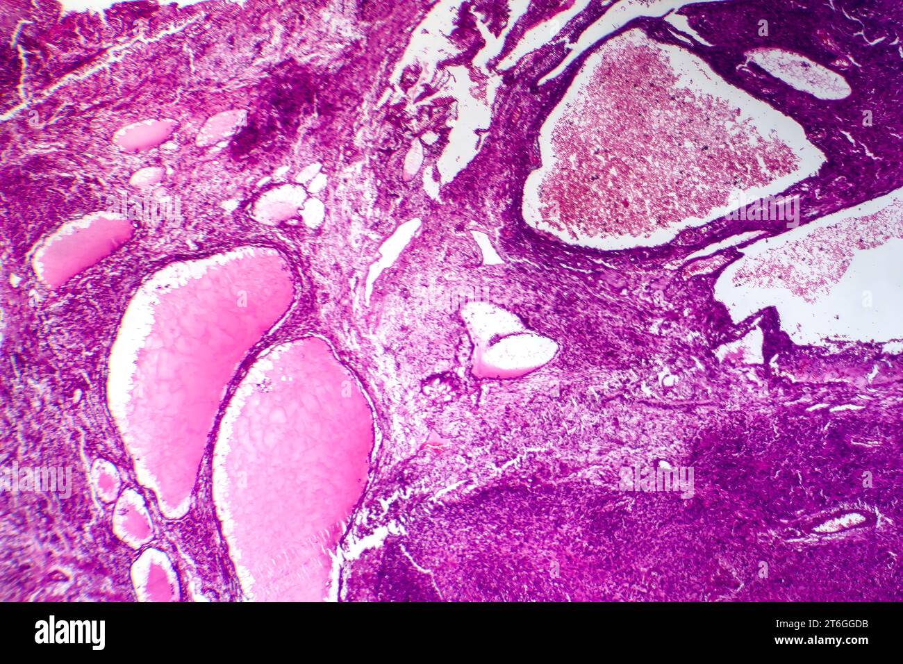 Photomicrographie d'un fibrosarcome, révélant des fibroblastes malins et du tissu conjonctif riche en collagène, caractéristique d'un cancer agressif des tissus mous. Banque D'Images