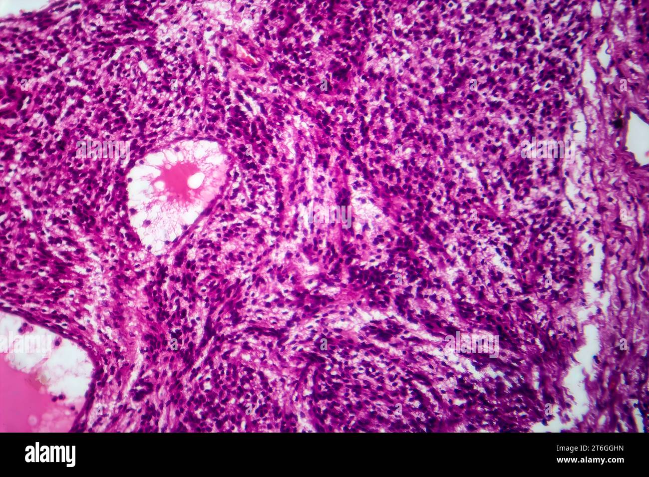 Photomicrographie d'un fibrosarcome, révélant des fibroblastes malins et du tissu conjonctif riche en collagène, caractéristique d'un cancer agressif des tissus mous. Banque D'Images