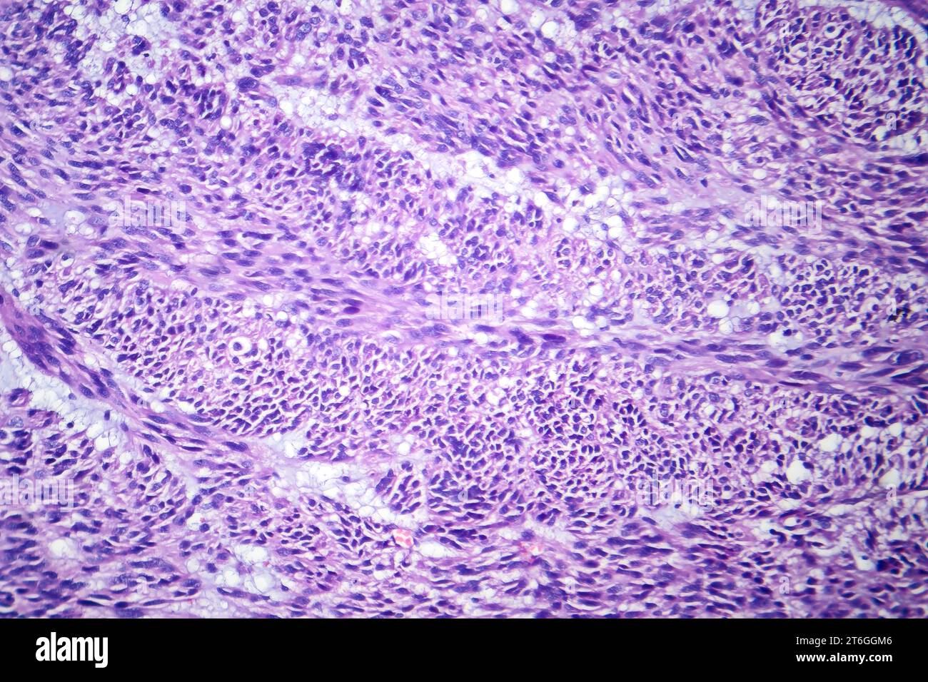 Photomicrographie d'un léiomyome, illustrant les cellules tumorales bénignes du muscle lisse dans le tissu utérin. Banque D'Images