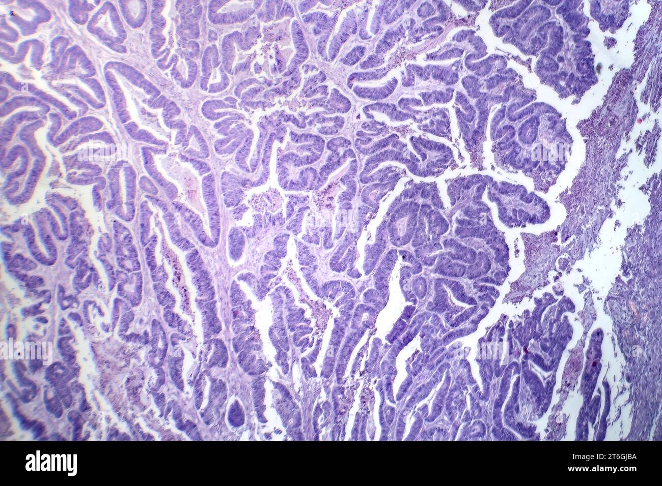 Photomicrographie d'un carcinome épidermoïde de l'oesophage, montrant des cellules squameuses malignes caractéristiques du cancer de l'oesophage. Banque D'Images