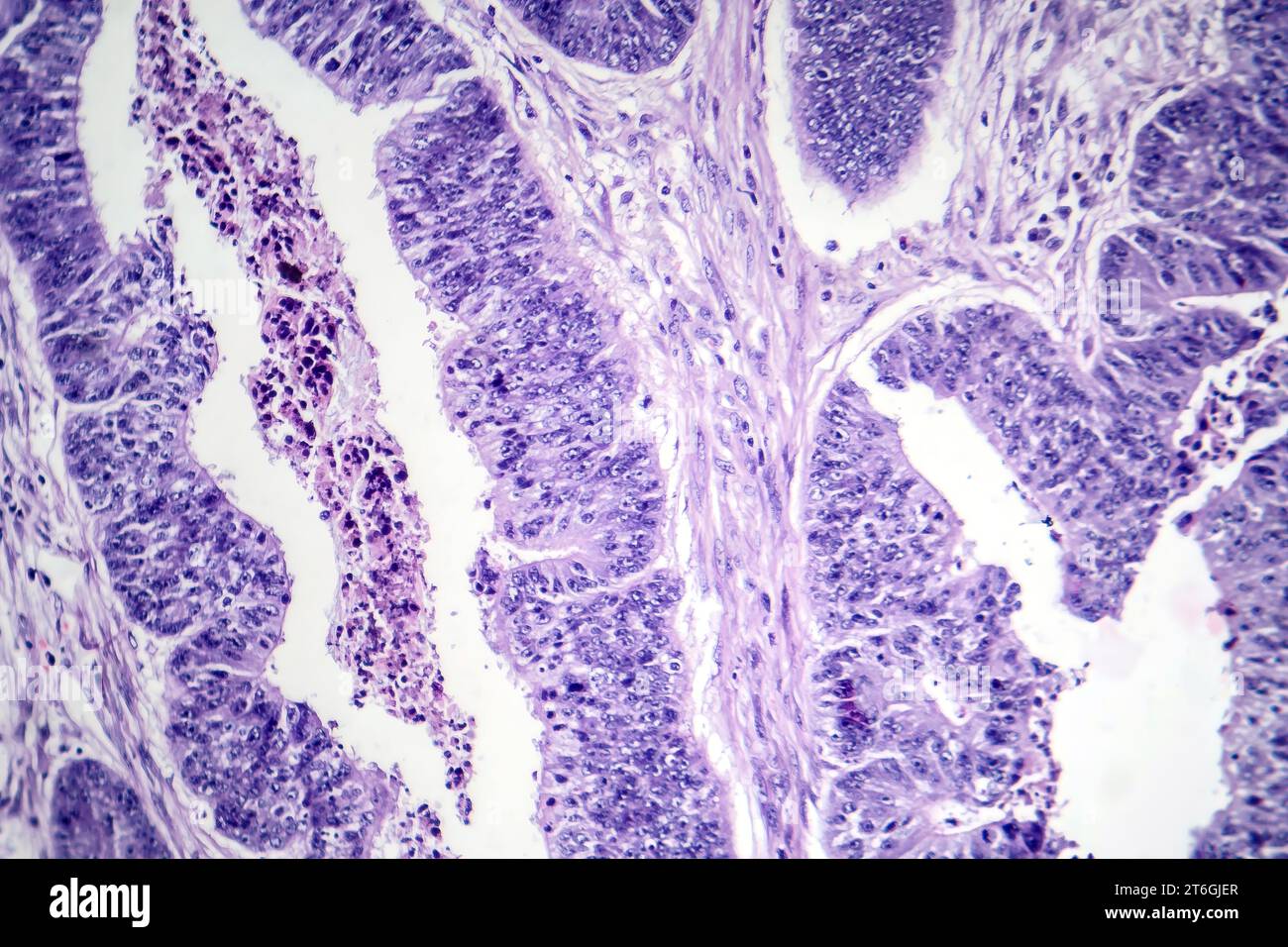 Photomicrographie d'un carcinome épidermoïde de l'oesophage, montrant des cellules squameuses malignes caractéristiques du cancer de l'oesophage. Banque D'Images