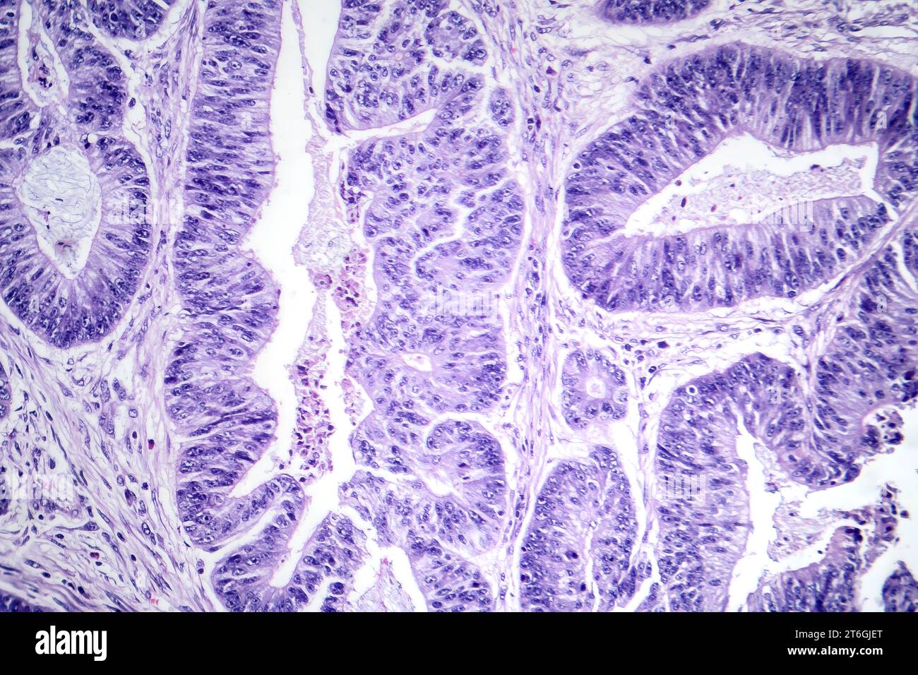 Photomicrographie d'un carcinome épidermoïde de l'oesophage, montrant des cellules squameuses malignes caractéristiques du cancer de l'oesophage. Banque D'Images