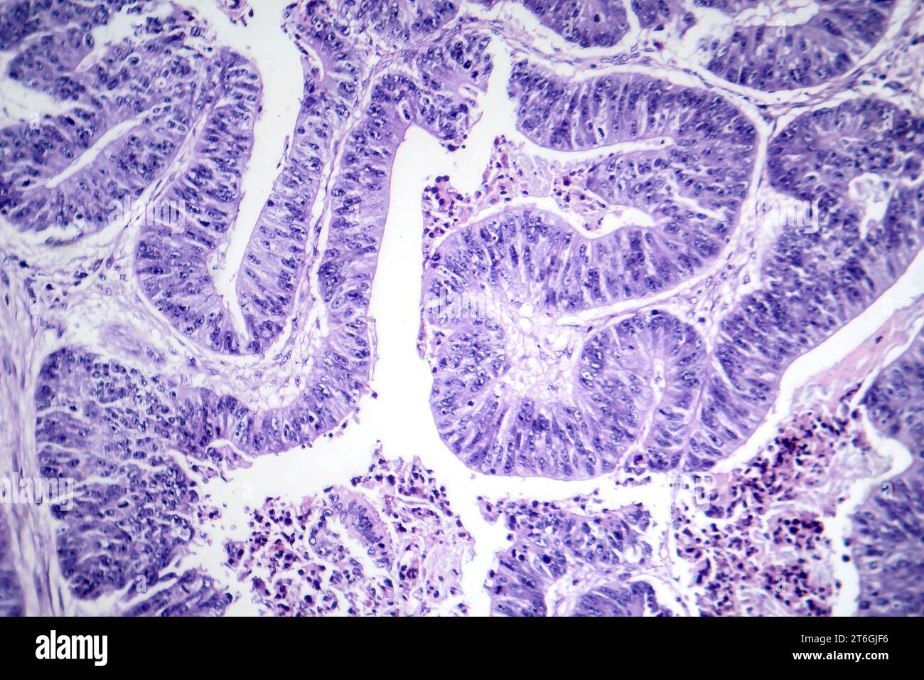 Photomicrographie d'un carcinome épidermoïde de l'oesophage, montrant des cellules squameuses malignes caractéristiques du cancer de l'oesophage. Banque D'Images