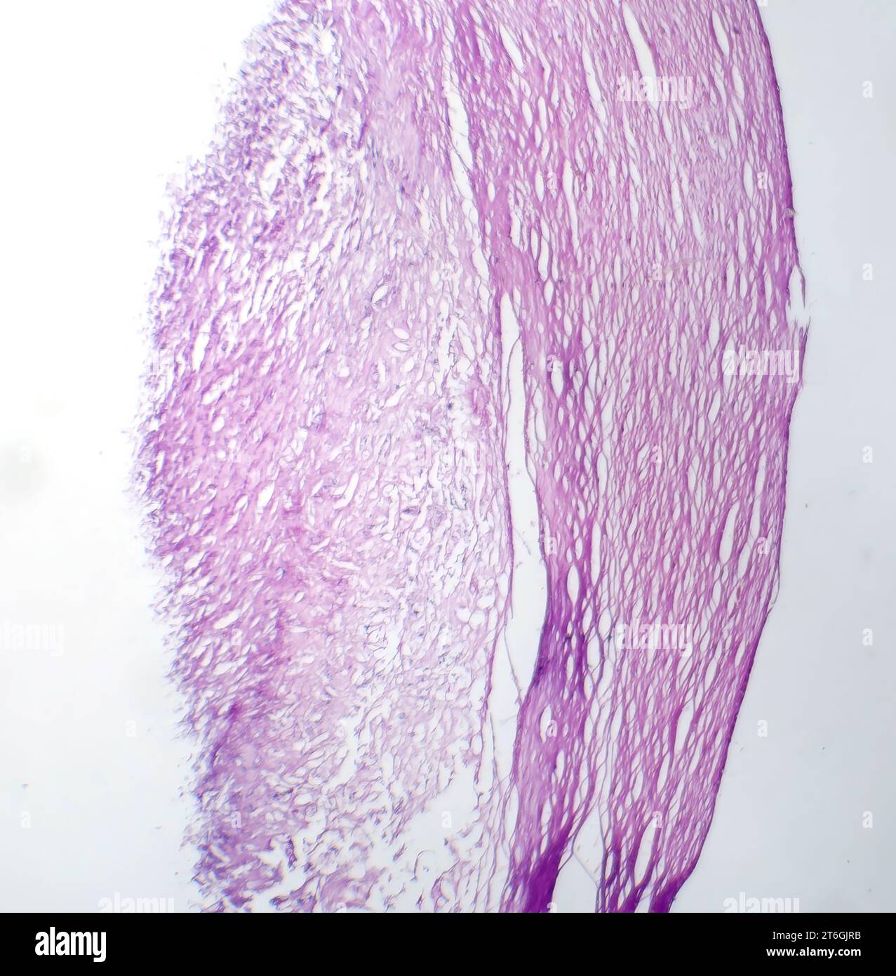 Photomicrographie du mélanome, mettant en évidence les mélanocytes malins, les cellules primaires responsables du cancer agressif de la peau. Banque D'Images