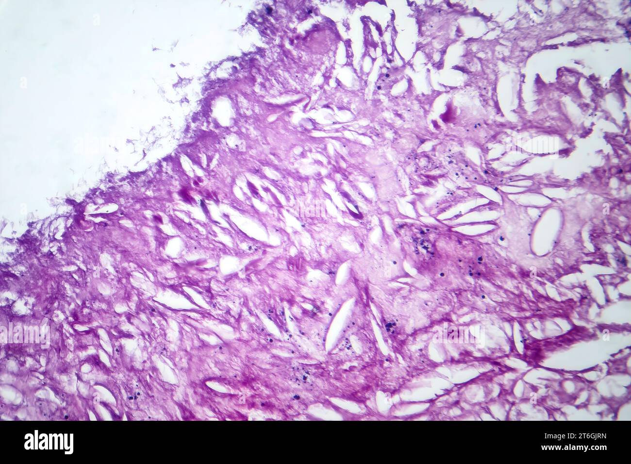 Photomicrographie du mélanome, mettant en évidence les mélanocytes malins, les cellules primaires responsables du cancer agressif de la peau. Banque D'Images