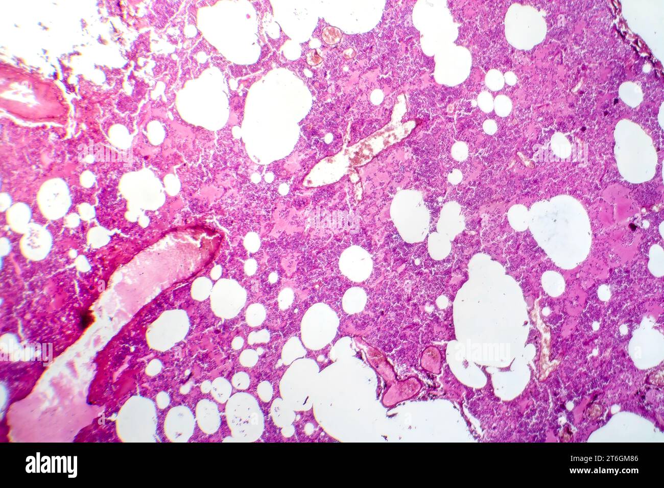Photomicrographie d'une pneumonie lobaire au cours de la période oedème hémorragique, montrant une inflammation du tissu pulmonaire avec modifications hémorragiques. Banque D'Images