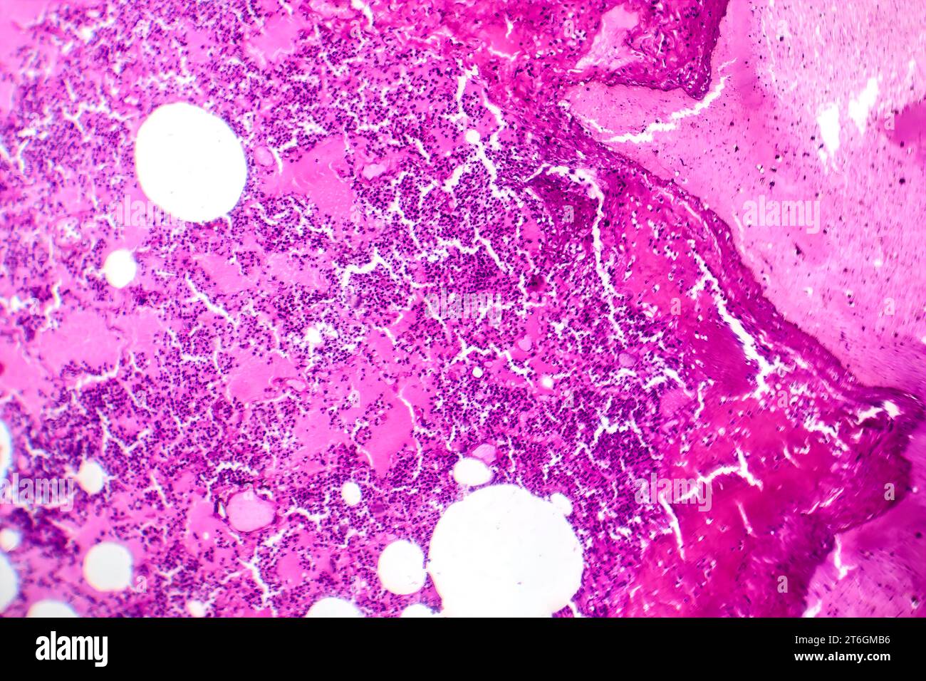 Photomicrographie d'une pneumonie lobaire au cours de la période oedème hémorragique, montrant une inflammation du tissu pulmonaire avec modifications hémorragiques. Banque D'Images