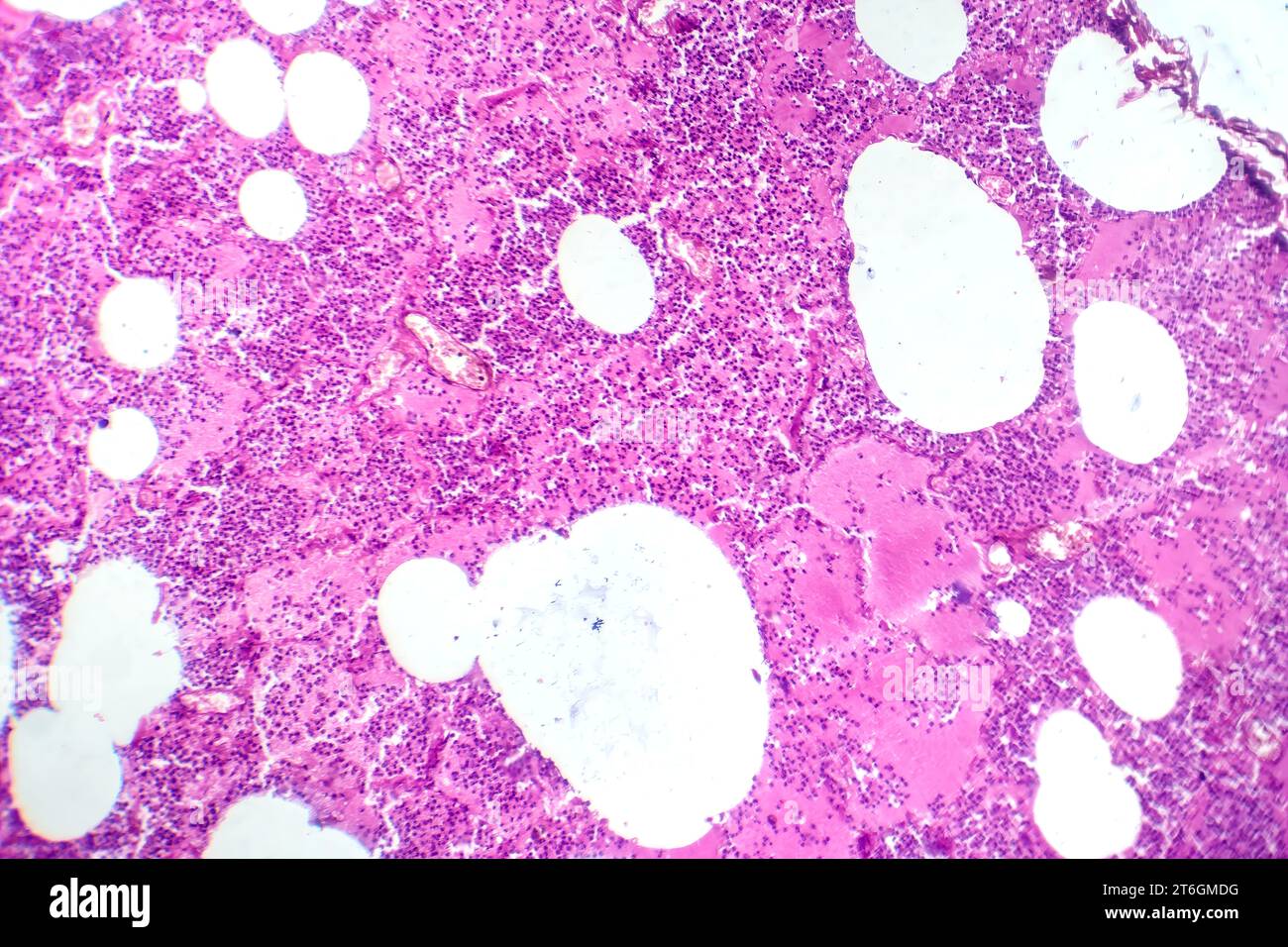Photomicrographie d'une pneumonie lobaire au cours de la période oedème hémorragique, montrant une inflammation du tissu pulmonaire avec modifications hémorragiques. Banque D'Images