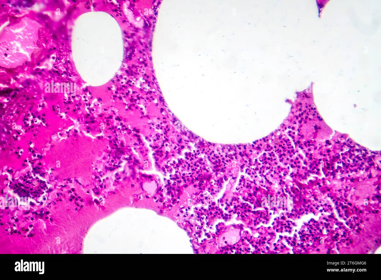Photomicrographie d'une pneumonie lobaire au cours de la période oedème hémorragique, montrant une inflammation du tissu pulmonaire avec modifications hémorragiques. Banque D'Images