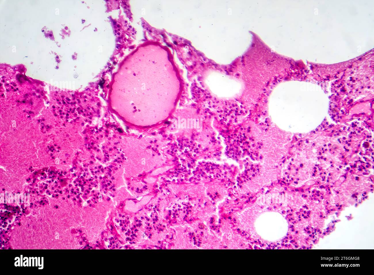 Photomicrographie d'une pneumonie lobaire au cours de la période oedème hémorragique, montrant une inflammation du tissu pulmonaire avec modifications hémorragiques. Banque D'Images