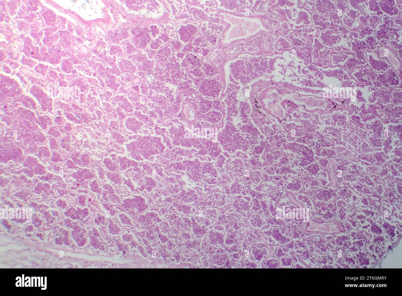 Photomicrographie d'une pneumonie lobaire en phase hépatique grise révélant une transition tissulaire pulmonaire avec alvéoles remplies d'exsudats. Banque D'Images