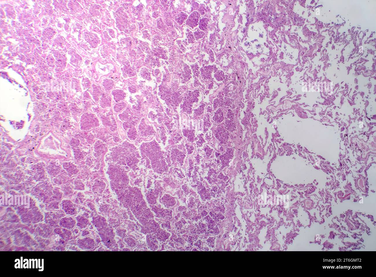 Photomicrographie d'une pneumonie lobaire en phase hépatique grise révélant une transition tissulaire pulmonaire avec alvéoles remplies d'exsudats. Banque D'Images