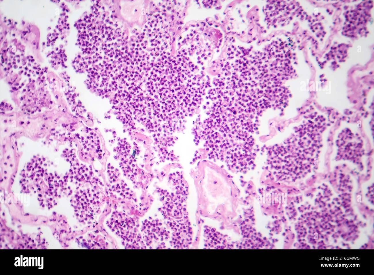 Photomicrographie d'une pneumonie lobaire en phase hépatique grise révélant une transition tissulaire pulmonaire avec alvéoles remplies d'exsudats. Banque D'Images