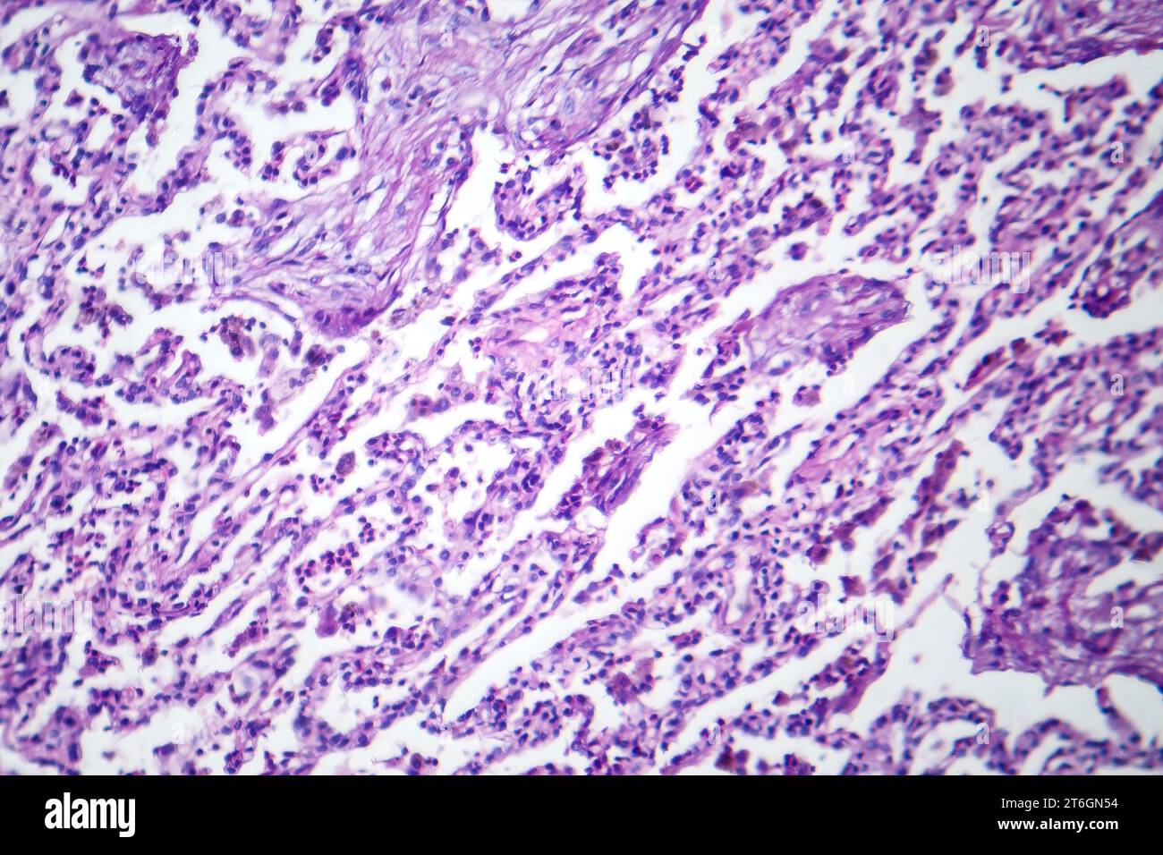 Photomicrographie de pneumonie lobaire en période de dissipation dissoute, montrant la résolution de l'inflammation et l'élimination du tissu pulmonaire. Banque D'Images