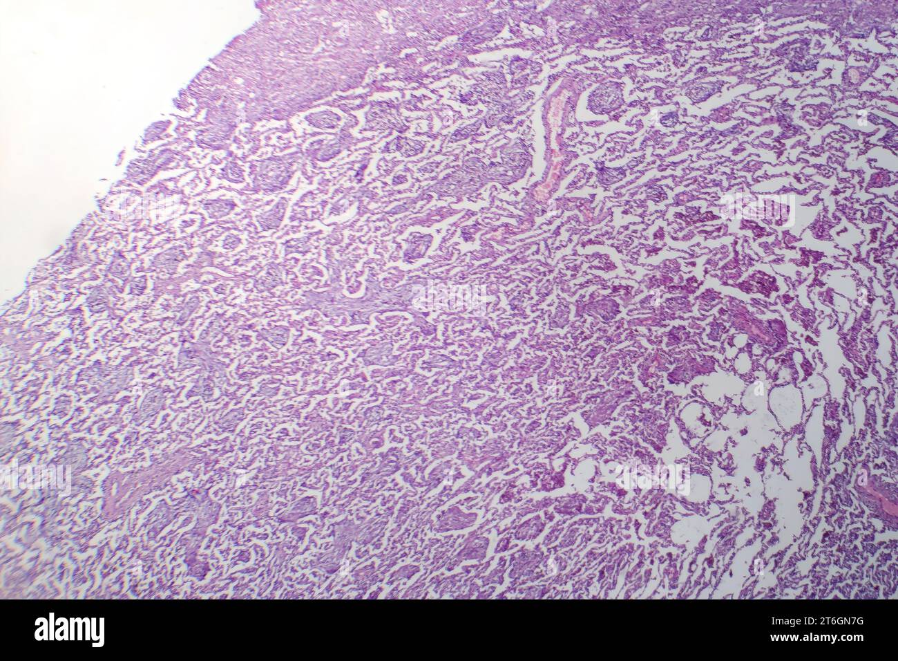 Photomicrographie de pneumonie lobaire en période de dissipation dissoute, montrant la résolution de l'inflammation et l'élimination du tissu pulmonaire. Banque D'Images