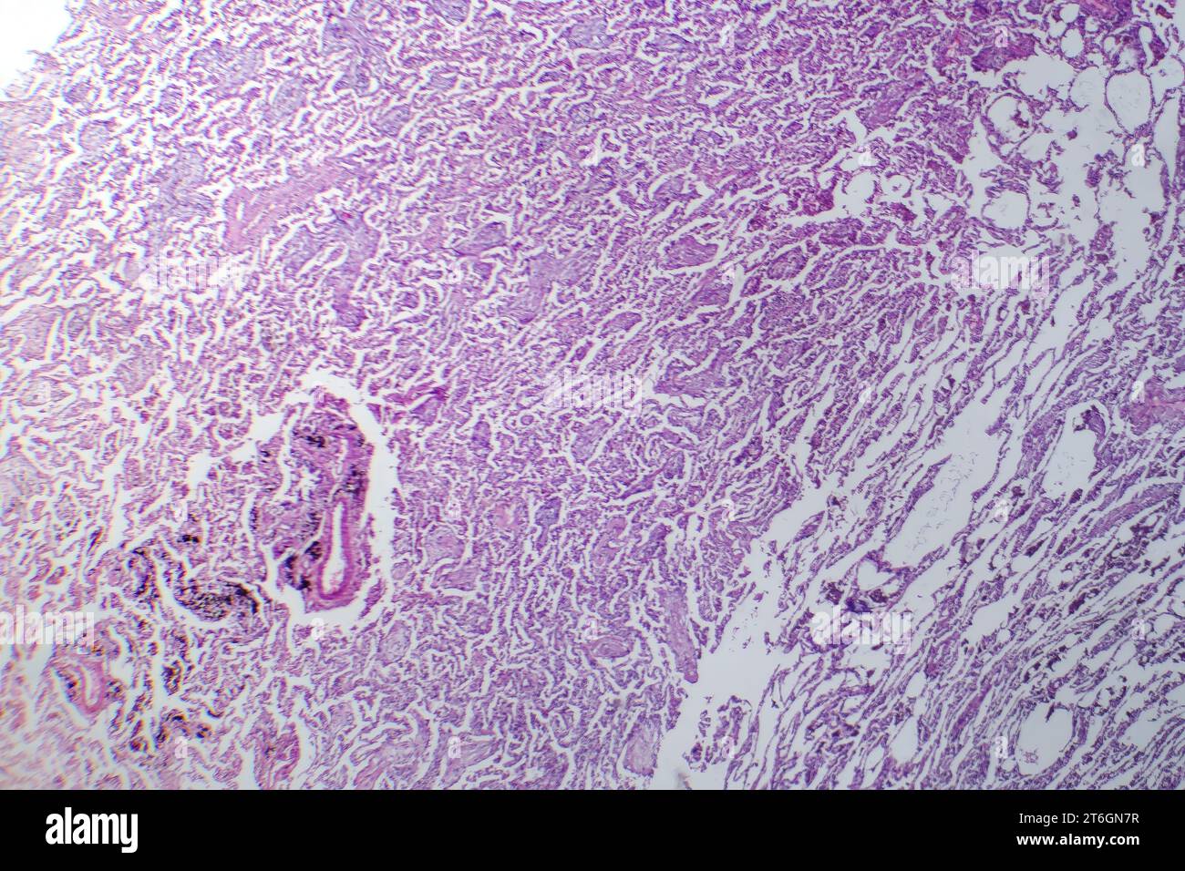 Photomicrographie de pneumonie lobaire en période de dissipation dissoute, montrant la résolution de l'inflammation et l'élimination du tissu pulmonaire. Banque D'Images