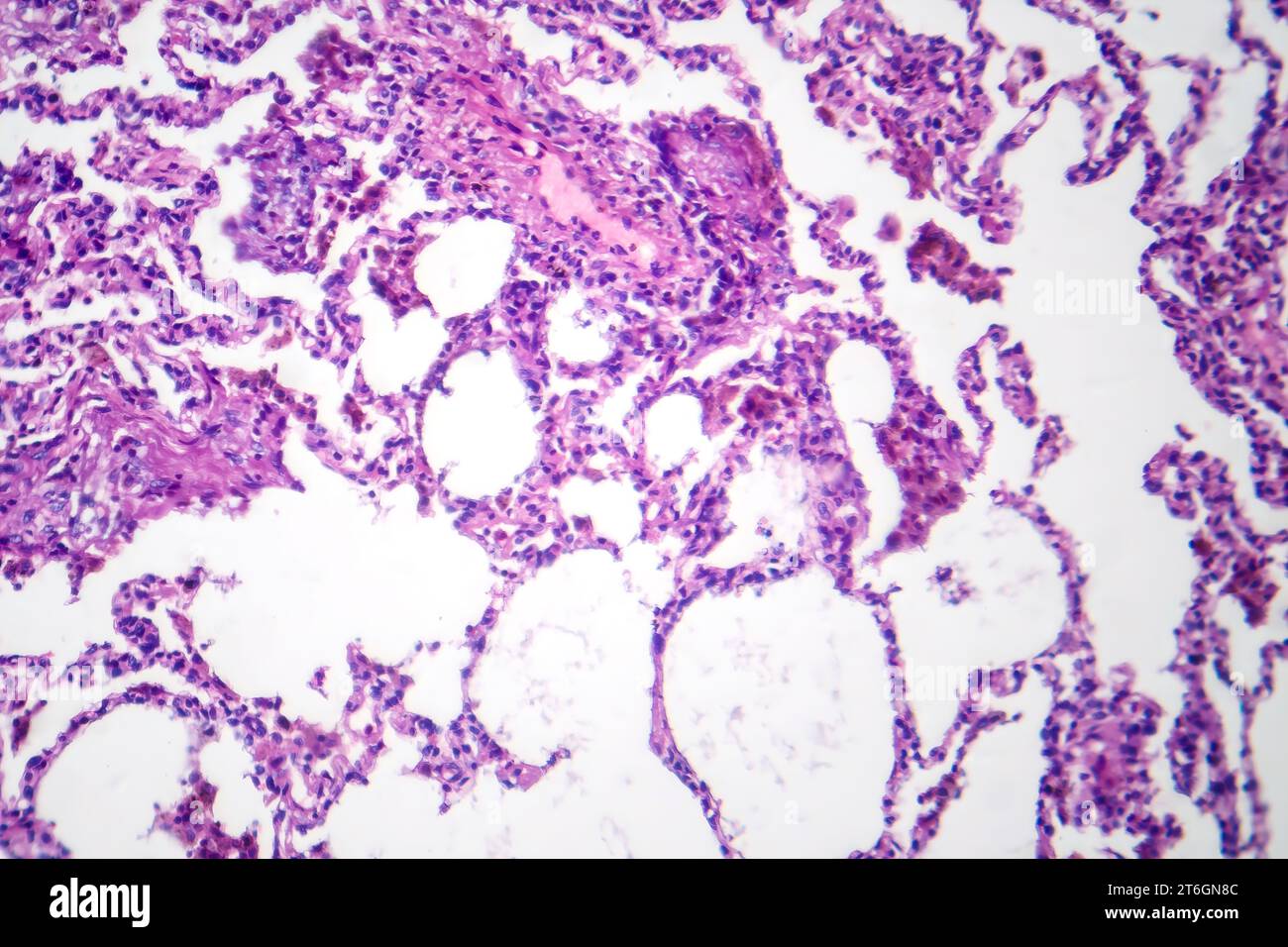 Photomicrographie de pneumonie lobaire en période de dissipation dissoute, montrant la résolution de l'inflammation et l'élimination du tissu pulmonaire. Banque D'Images