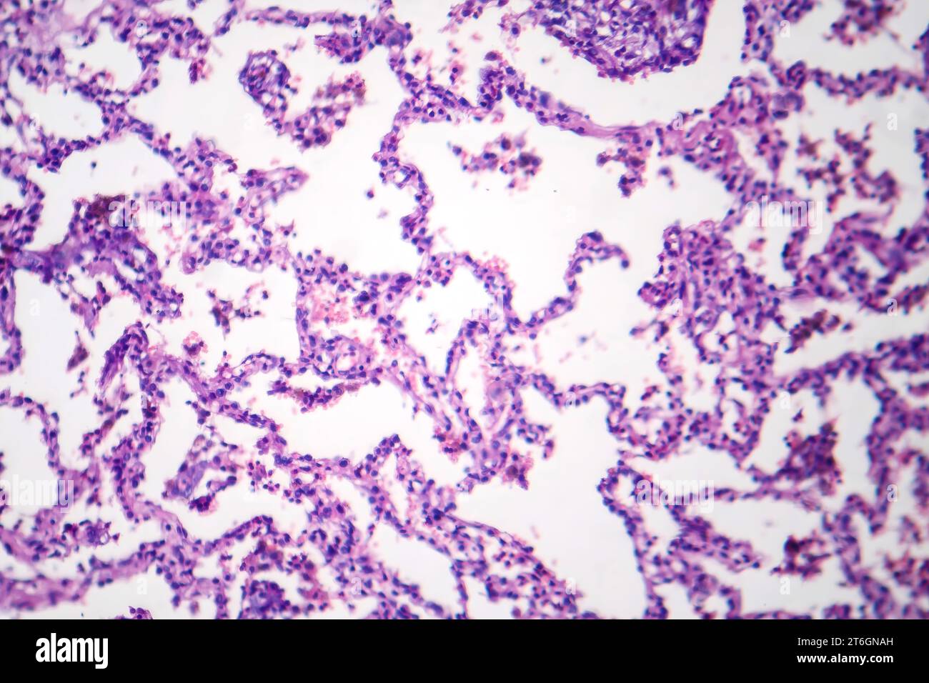 Photomicrographie de pneumonie lobaire en période de dissipation dissoute, montrant la résolution de l'inflammation et l'élimination du tissu pulmonaire. Banque D'Images
