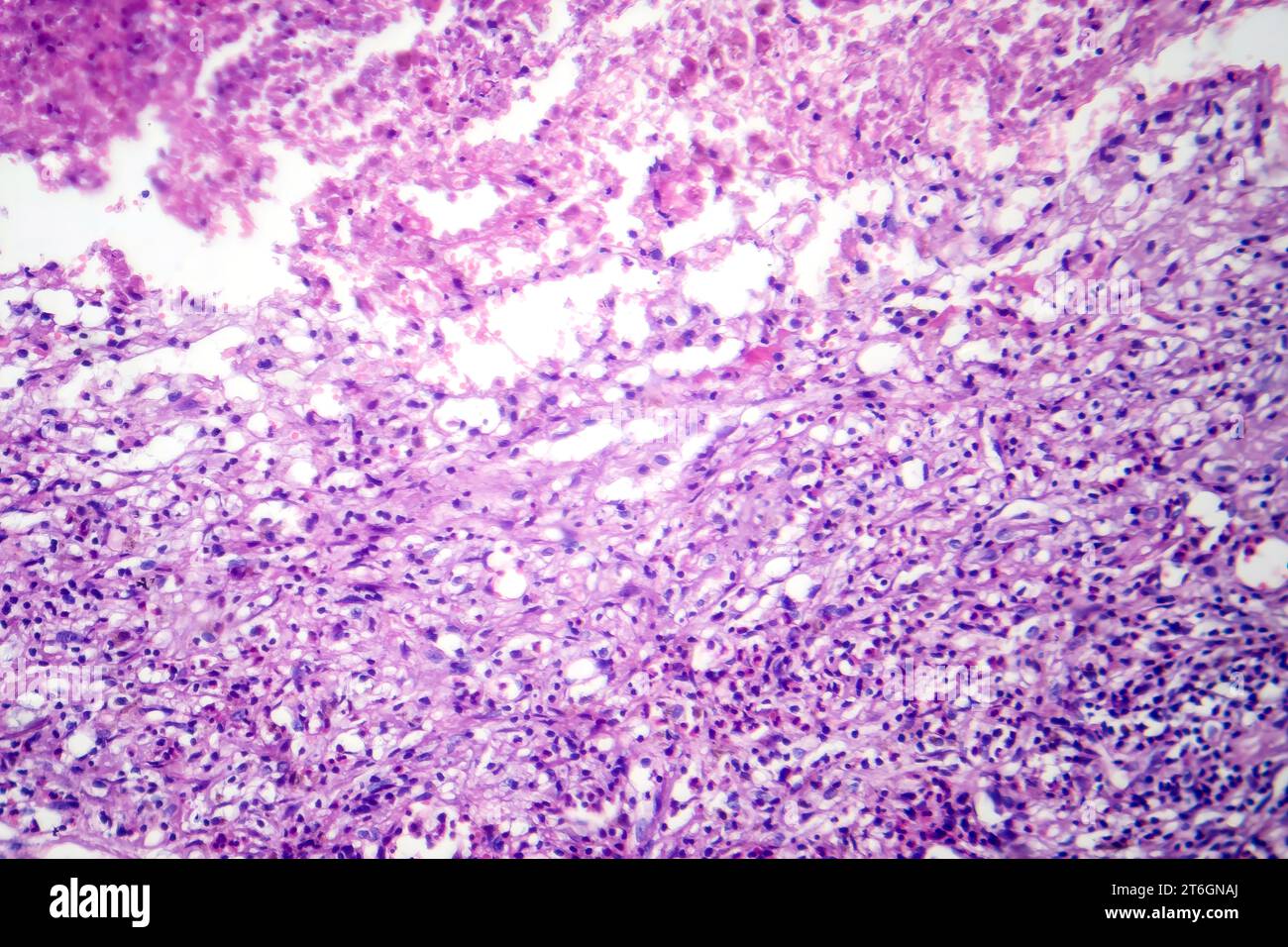 Photomicrographie de pneumonie lobaire en période de dissipation dissoute, montrant la résolution de l'inflammation et l'élimination du tissu pulmonaire. Banque D'Images