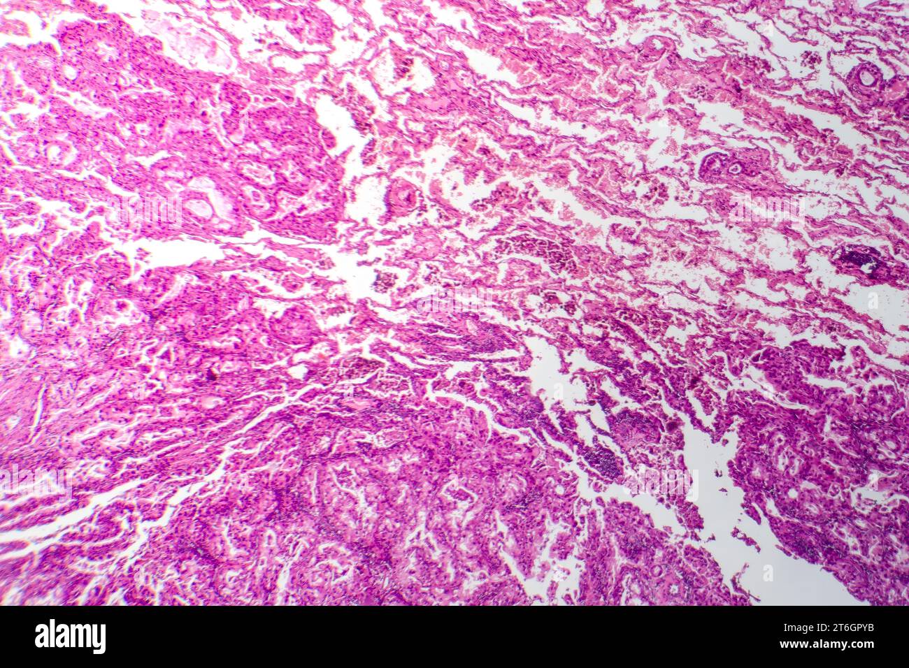 Photomicrographie du tissu cancéreux du poumon, révélant des cellules malignes et la croissance anormale caractéristique de la malignité du poumon. Banque D'Images