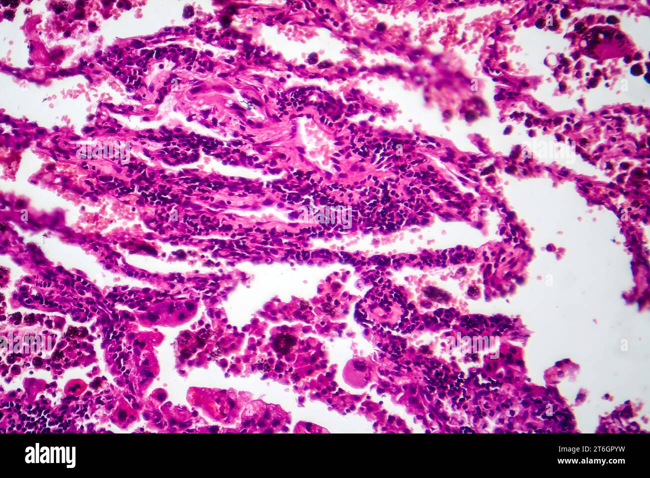 Photomicrographie du tissu cancéreux du poumon, révélant des cellules malignes et la croissance anormale caractéristique de la malignité du poumon. Banque D'Images