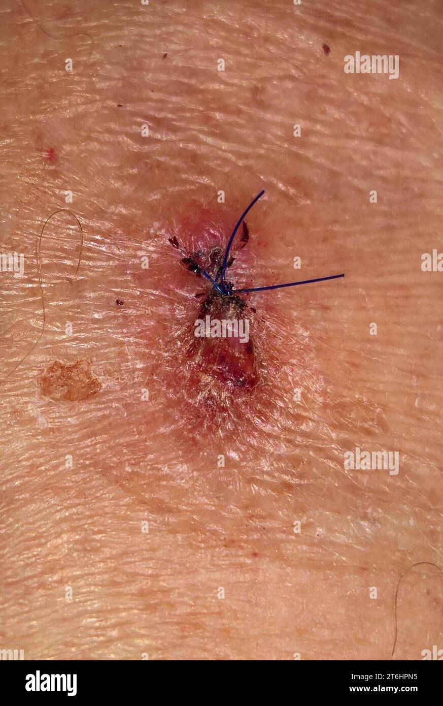 Trypophobia Löcher In Der Haut Termin beim Hautarzt bzw in der Dermatologie. Opération Naht und Fäden