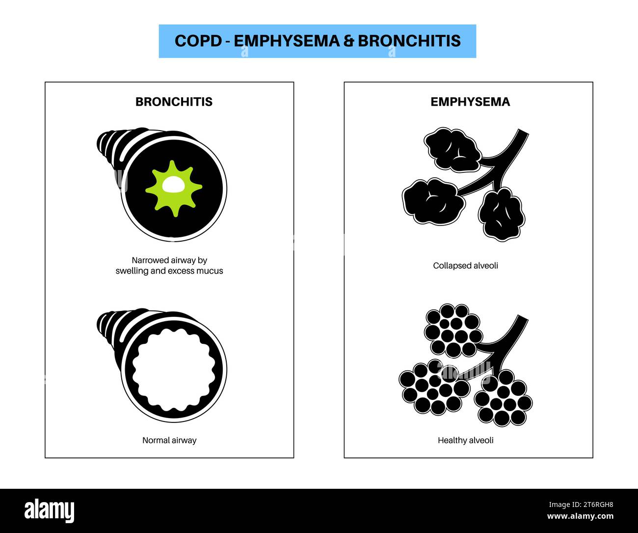 Maladie pulmonaire obstructive chronique, illustration Banque D'Images