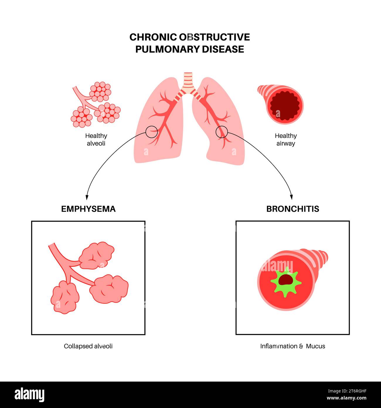 Maladie pulmonaire obstructive chronique, illustration Banque D'Images
