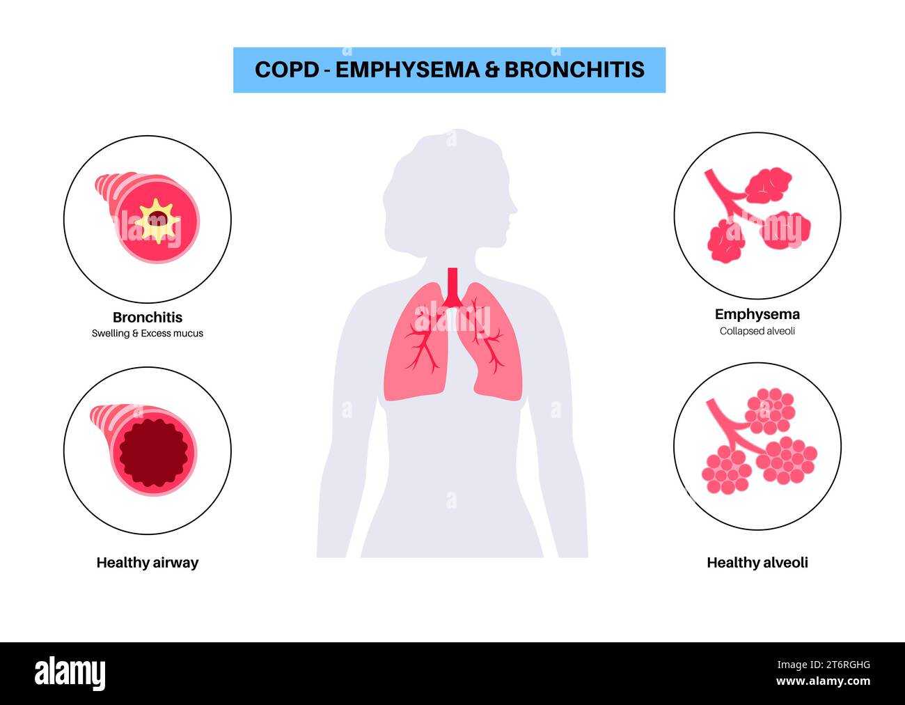 Maladie pulmonaire obstructive chronique, illustration Banque D'Images