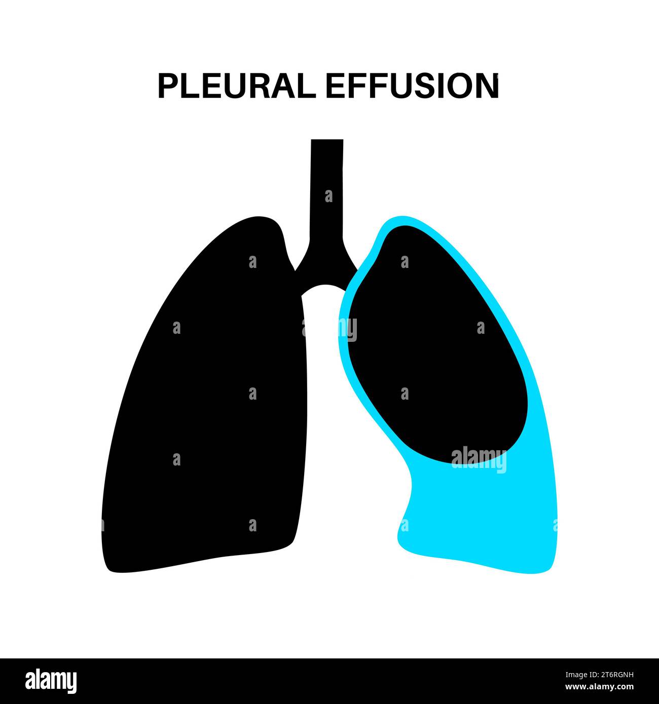 Épanchement pleural, illustration Banque D'Images