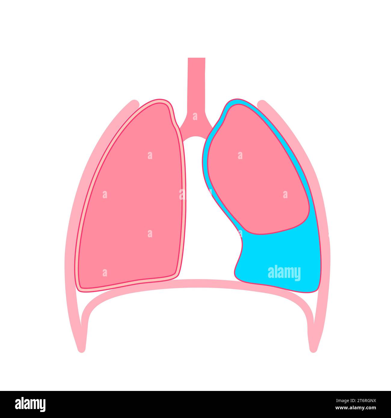 Épanchement pleural, illustration Banque D'Images